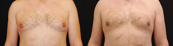 Male Breast Reduction before and after photos by Dr. Philip C. Kierney in Puyallup, WA